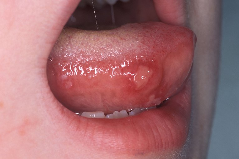 Hand foot and mouth image_NHS.jpg